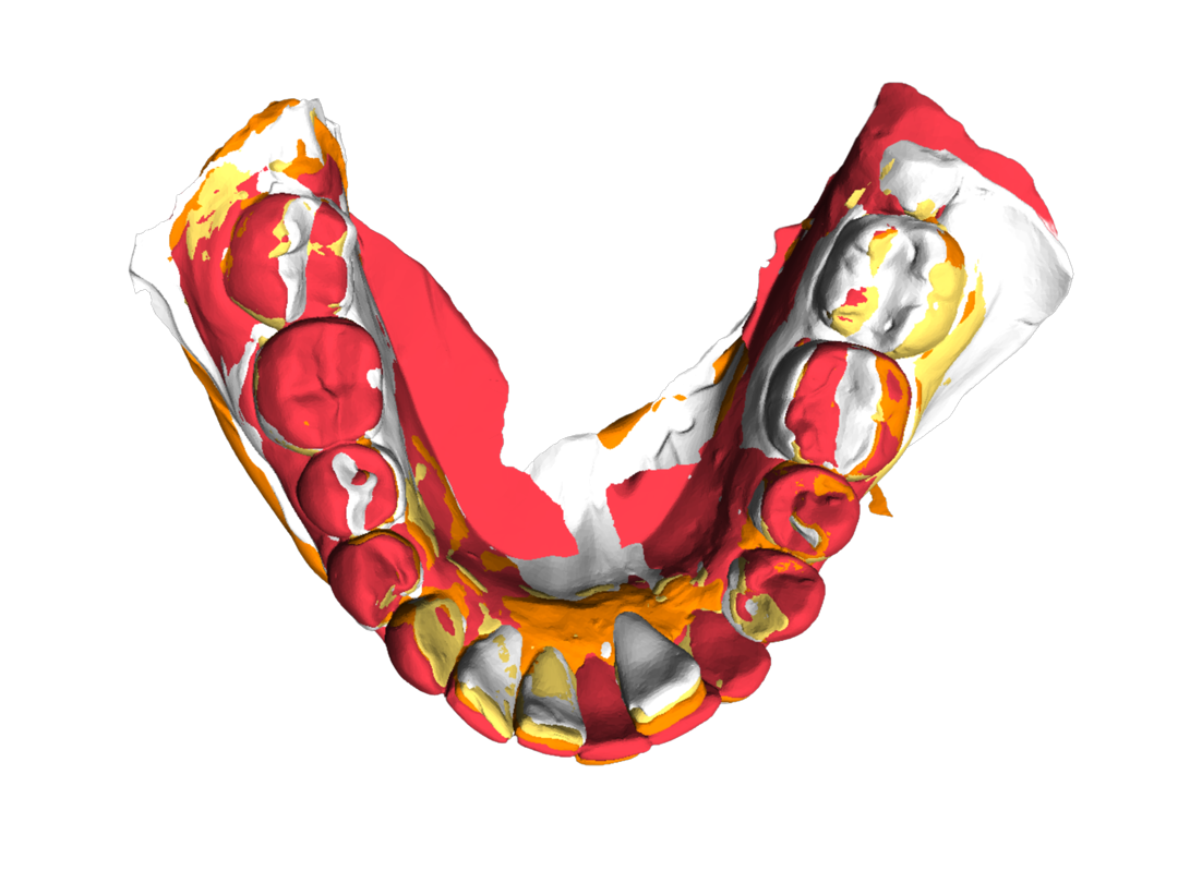 3DDA digital dental model comparison